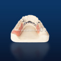 Cast Metal Partial Dentures
